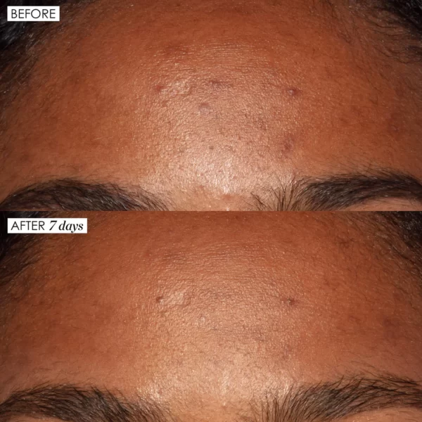 LACTIC ACID TREATMENT - Image 5